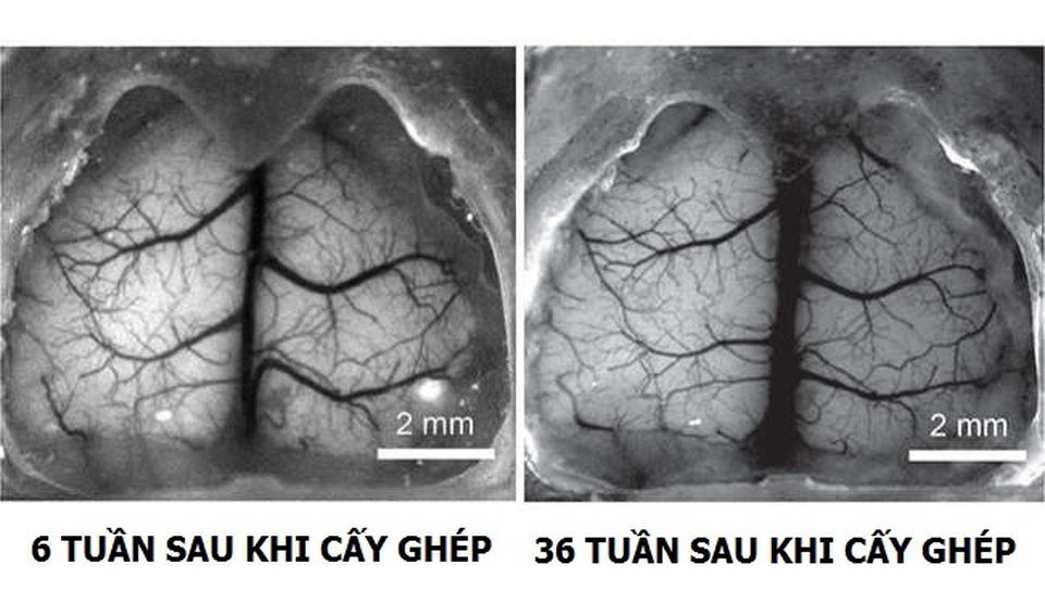 Cấy ghép xương sọ trong suốt cho phép quan sát trực tiếp bộ não đang sống - 2 Cấy ghép xương sọ trong suốt cho phép quan sát trực tiếp bộ não đang sống - 2