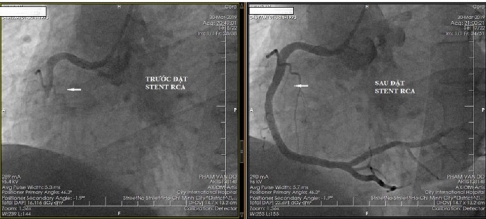 Du khách Úc bị nhồi máu cơ tim sau chuyến bay - 1 Du khách Úc bị nhồi máu cơ tim sau chuyến bay - 1