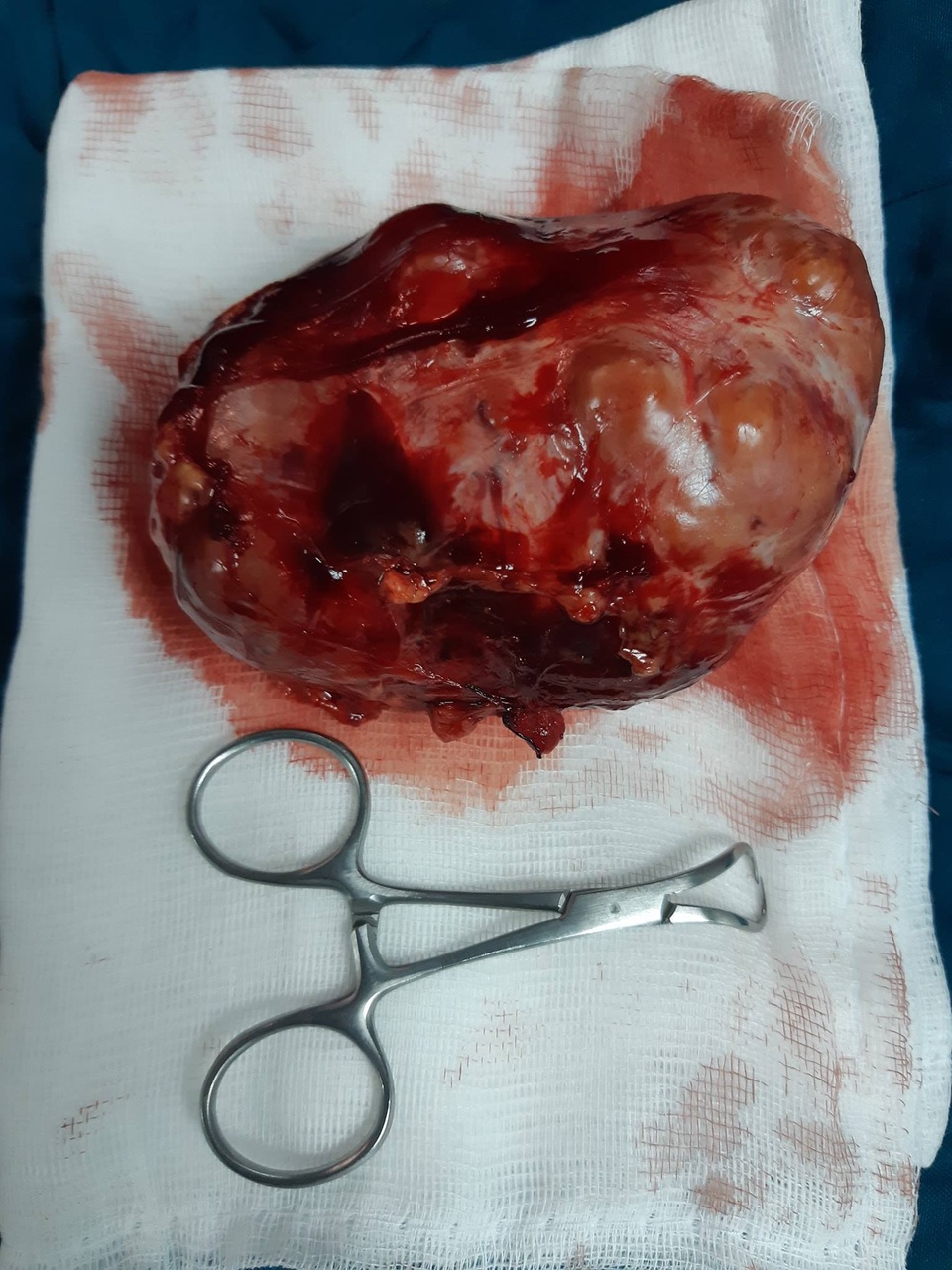 Mổ thành công khối u nặng khoảng 1 kg ra khỏi cơ thể người - 1 Mổ thành công khối u nặng khoảng 1 kg ra khỏi cơ thể người - 1
