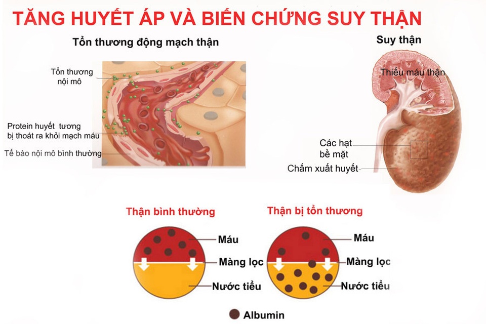 3 quy tắc giúp người cao huyết áp cả đời không lo suy thận - 1 3 quy tắc giúp người cao huyết áp cả đời không lo suy thận - 1