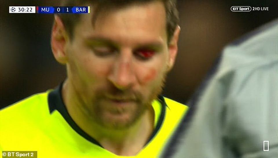 Messi chảy máu đầm đìa sau khi dính “đòn” của Smalling - 8 Messi chảy máu đầm đìa sau khi dính “đòn” của Smalling - 8