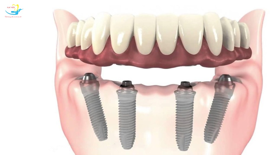 Cấy ghép implant All on 4: Giải pháp cho người mất răng toàn hàm - 1 Cấy ghép implant All on 4: Giải pháp cho người mất răng toàn hàm - 1