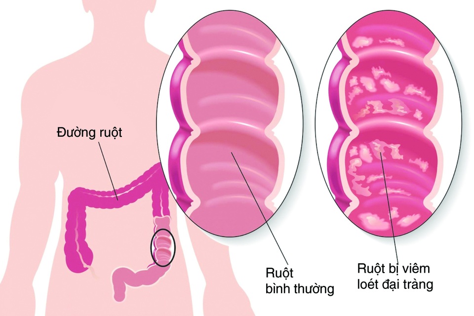 Lợi ích của bào tử lợi khuẩn trong việc hỗ trợ điều trị viêm đại tràng - 1 Lợi ích của bào tử lợi khuẩn trong việc hỗ trợ điều trị viêm đại tràng - 1