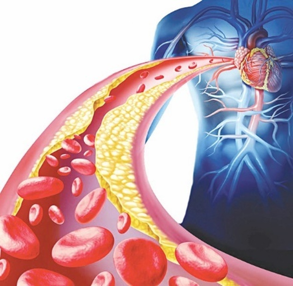 Học cách xử lý mỡ máu cao đơn giản của người Nhật - 1 Học cách xử lý mỡ máu cao đơn giản của người Nhật - 1