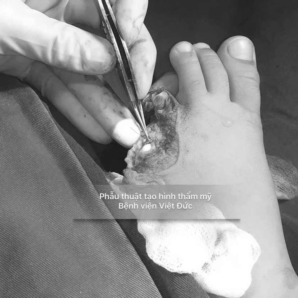 Va quệt ống xả phủ inox của xe máy đi ngược chiều, bé trai 6 tuổi mất bay ngón chân út - 1