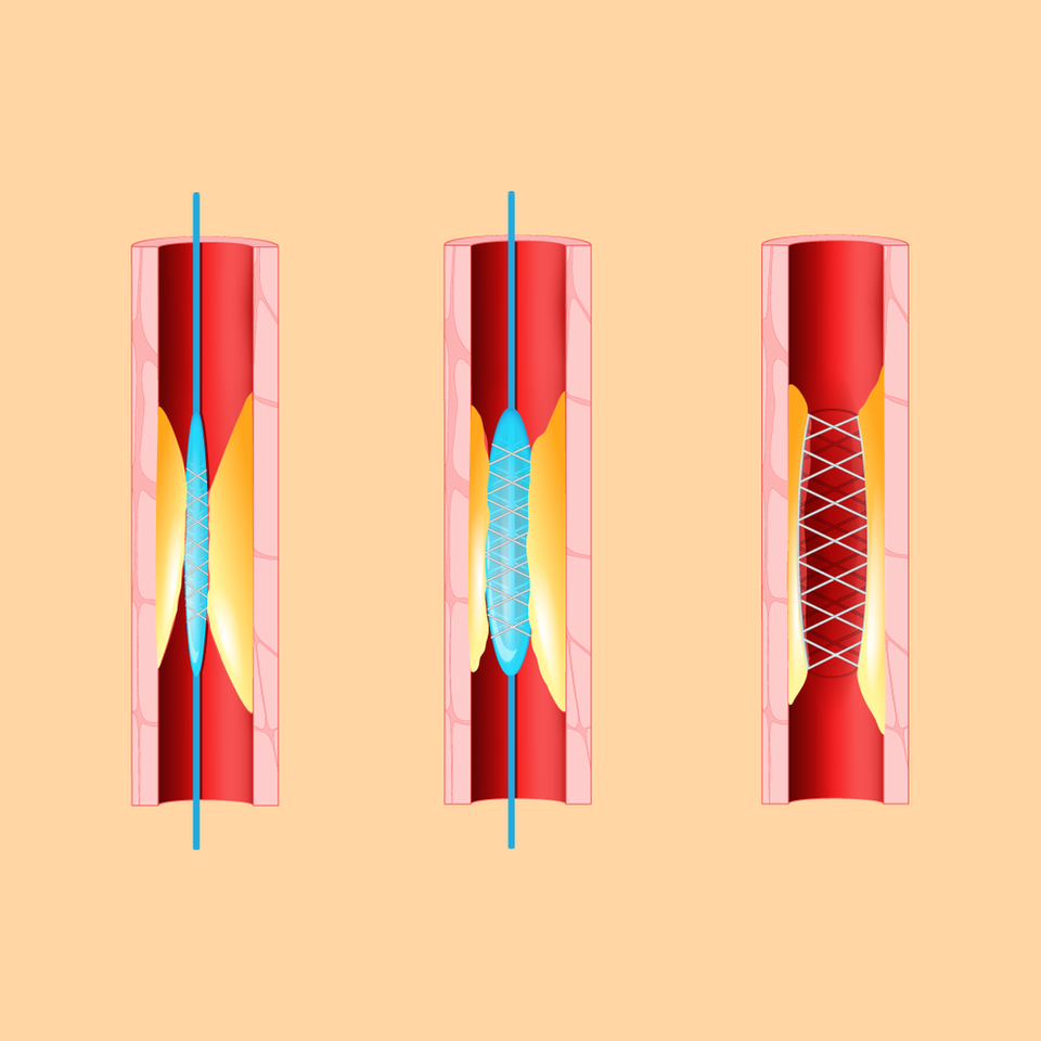 Stent tim: Đặt hay không đặt? - 1 Stent tim: Đặt hay không đặt? - 1