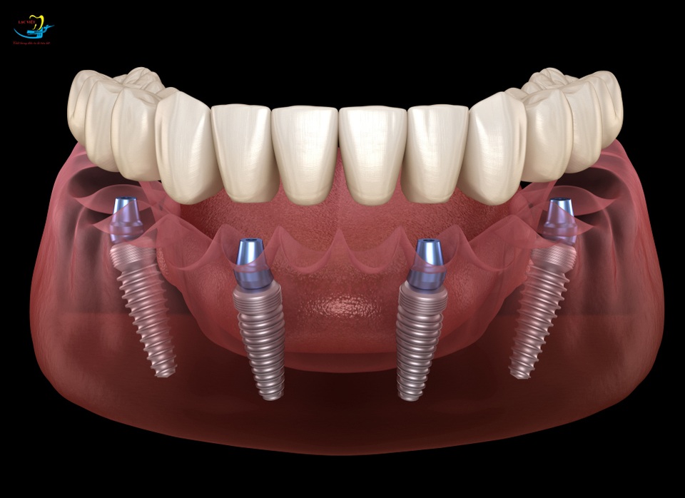 Biến chứng khi cấy ghép implant - 1 Biến chứng khi cấy ghép implant - 1