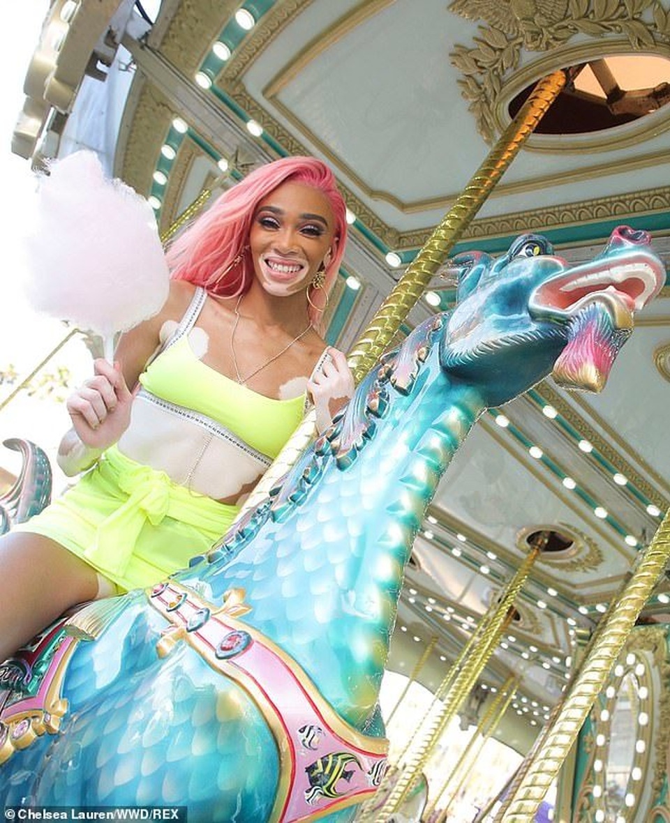 Siêu mẫu bạch biến bốc lửa với váy vàng chanh - 1 Siêu mẫu bạch biến bốc lửa với váy vàng chanh - 1