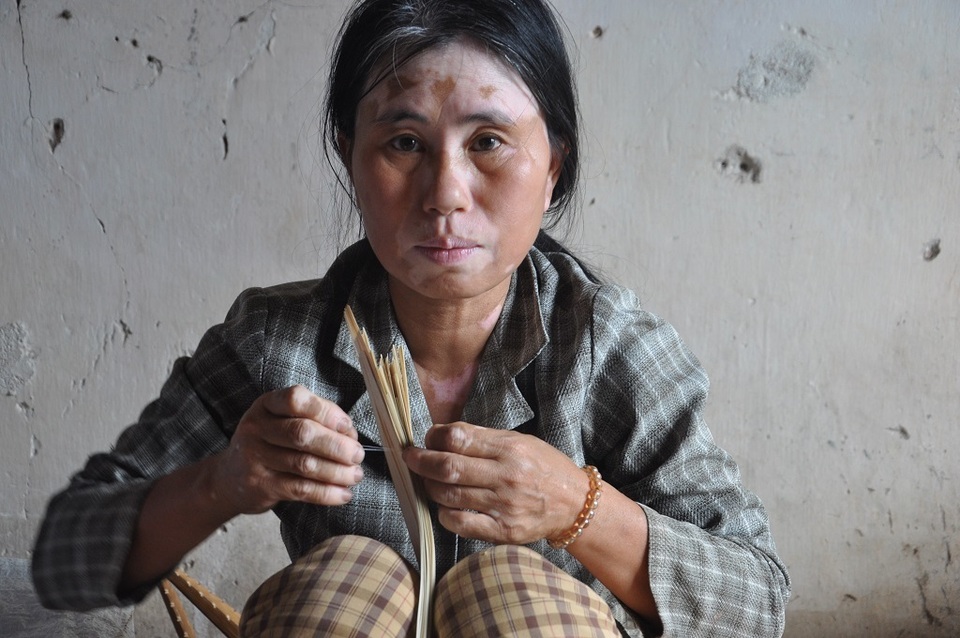 Người phụ nữ mang khuôn mặt lạ cả đời cóp nhặt chờ ngày chữa bệnh hiểm cho em! - 1