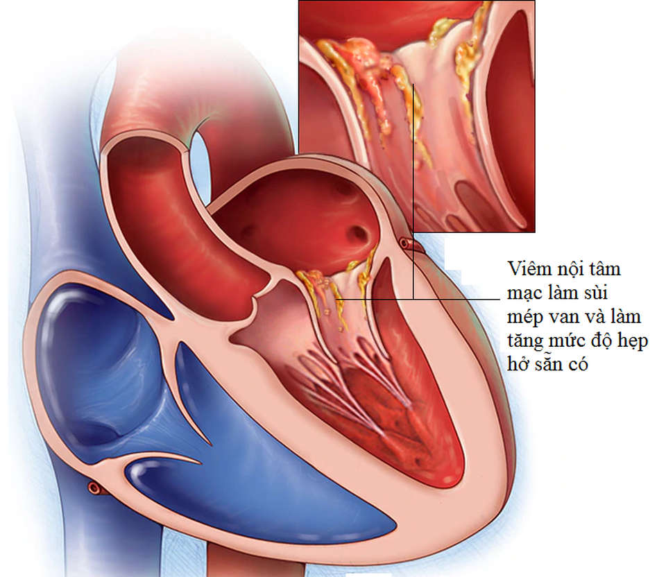 Phòng viêm nội tâm mạc nhiễm khuẩn tốt, hẹp hở van tim đỡ rủi ro - 1 Phòng viêm nội tâm mạc nhiễm khuẩn tốt, hẹp hở van tim đỡ rủi ro - 1