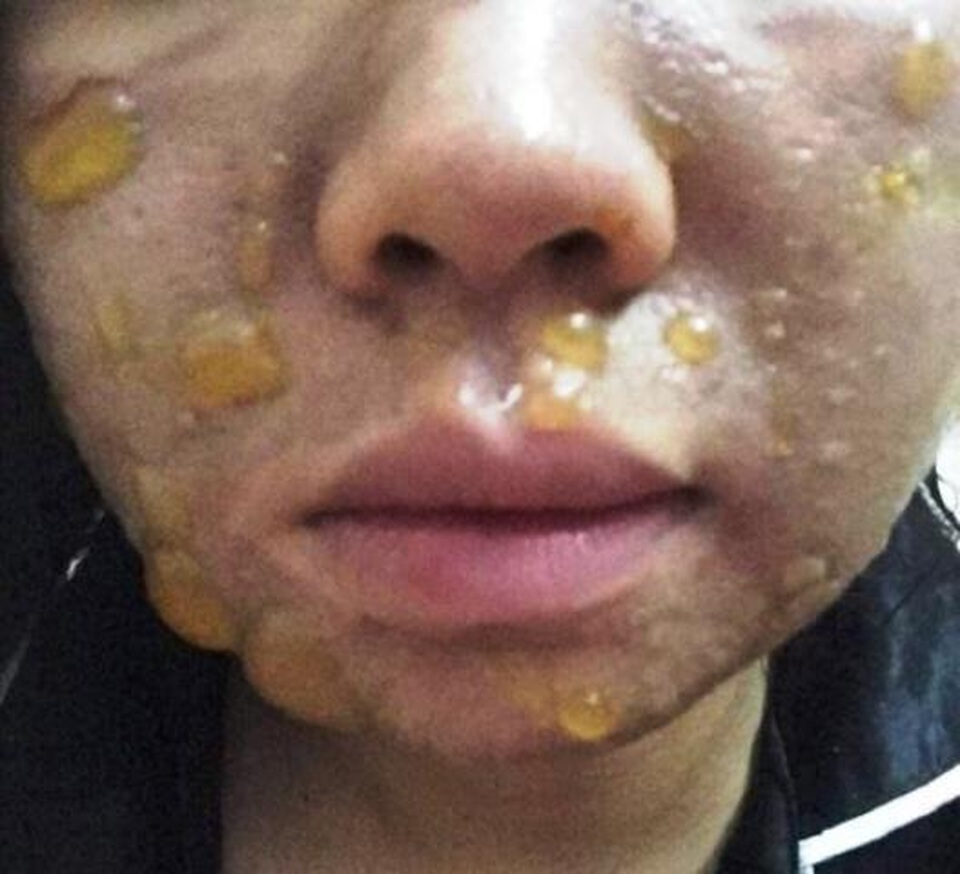 Kinh hoàng da nổi bọng nước, bỏng rát vì tự bôi sản phẩm làm đẹp - 1 Kinh hoàng da nổi bọng nước, bỏng rát vì tự bôi sản phẩm làm đẹp - 1
