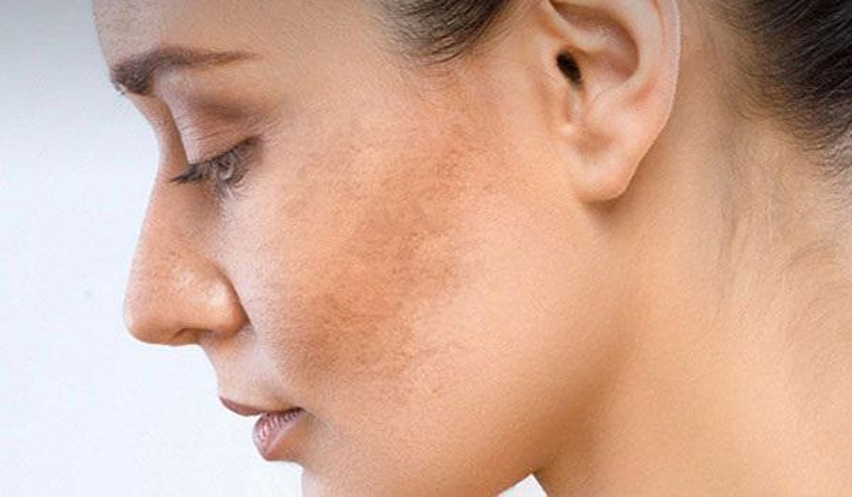 Chia tay nám “khó hóa dễ” nếu bạn biết đến Glutathione BC White - 1 Chia tay nám “khó hóa dễ” nếu bạn biết đến Glutathione BC White - 1