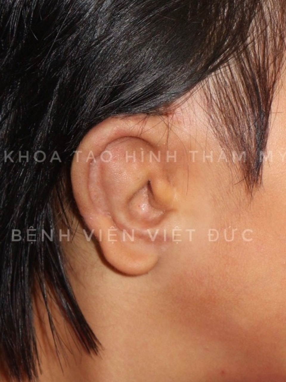 Cậu bé thoát cảnh tai nhỏ như vẩy hến nhờ tạo hình tai mới - 2 Cậu bé thoát cảnh tai nhỏ như vẩy hến nhờ tạo hình tai mới - 2