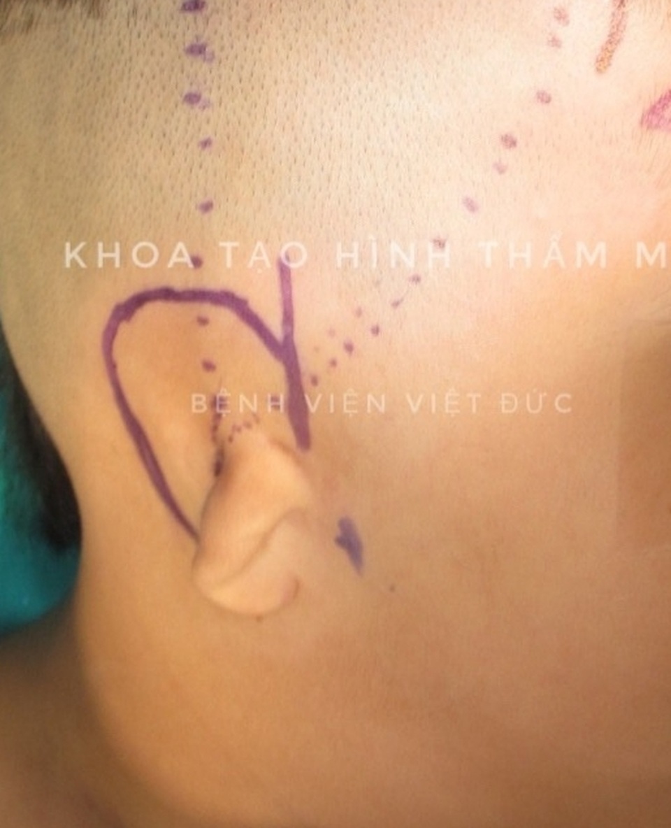 Cậu bé thoát cảnh tai nhỏ như vẩy hến nhờ tạo hình tai mới - 1 Cậu bé thoát cảnh tai nhỏ như vẩy hến nhờ tạo hình tai mới - 1