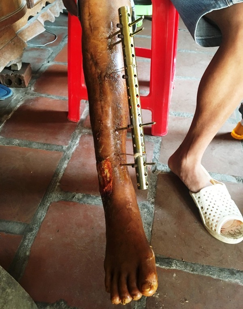 Gần 56 triệu đồng đến với hoàn cảnh anh Mã Văn Thuận - 1