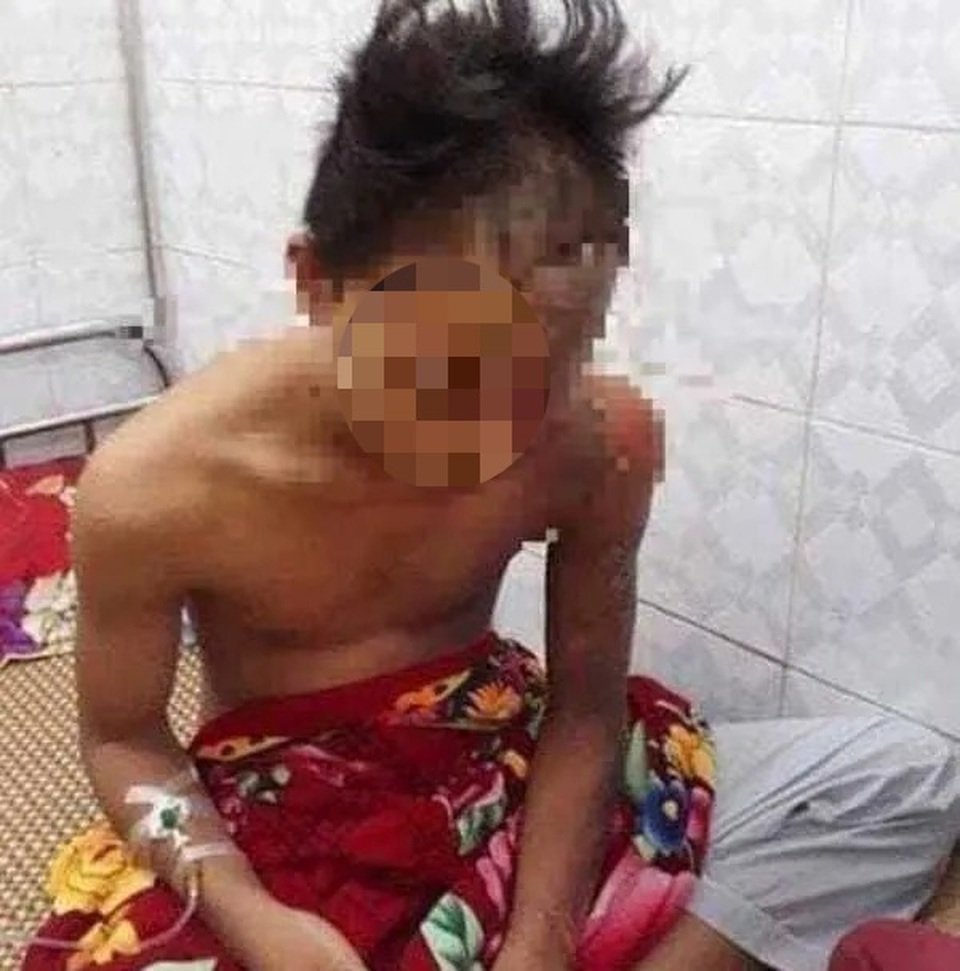 Nam sinh lớp 11 bị sét đánh cháy sém, bỏng độ 4 ở vùng đầu - 1