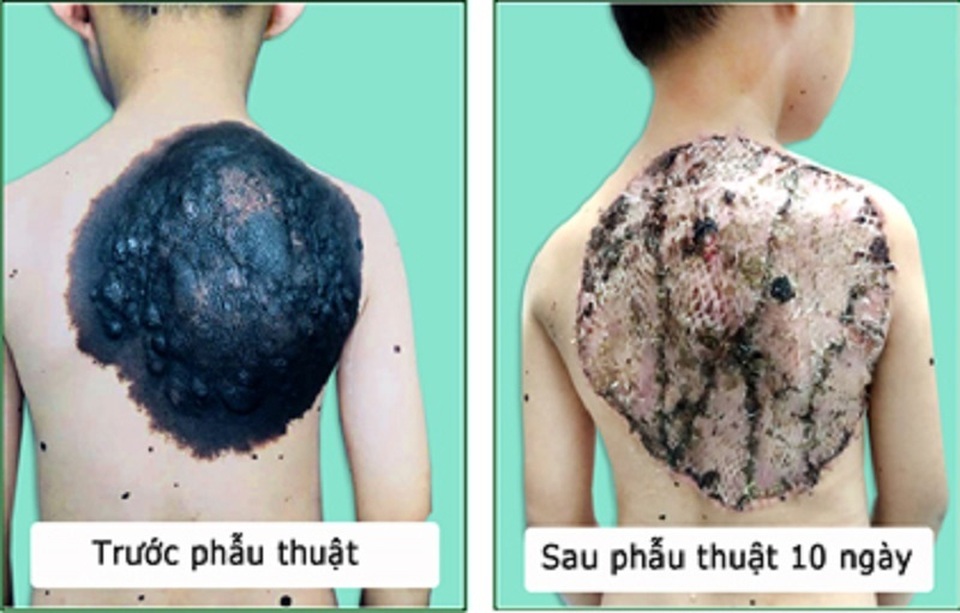 “Gỡ” mai rùa trên lưng cho cậu bé 7 tuổi - 1