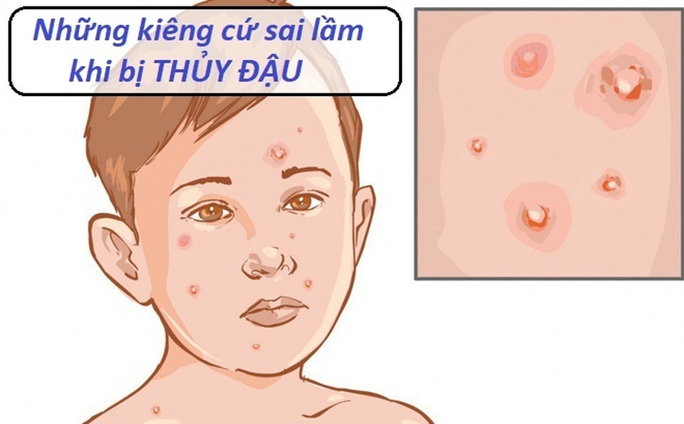 Bệnh thủy đậu và những sai lầm trong kiêng cữ - 1 Bệnh thủy đậu và những sai lầm trong kiêng cữ - 1