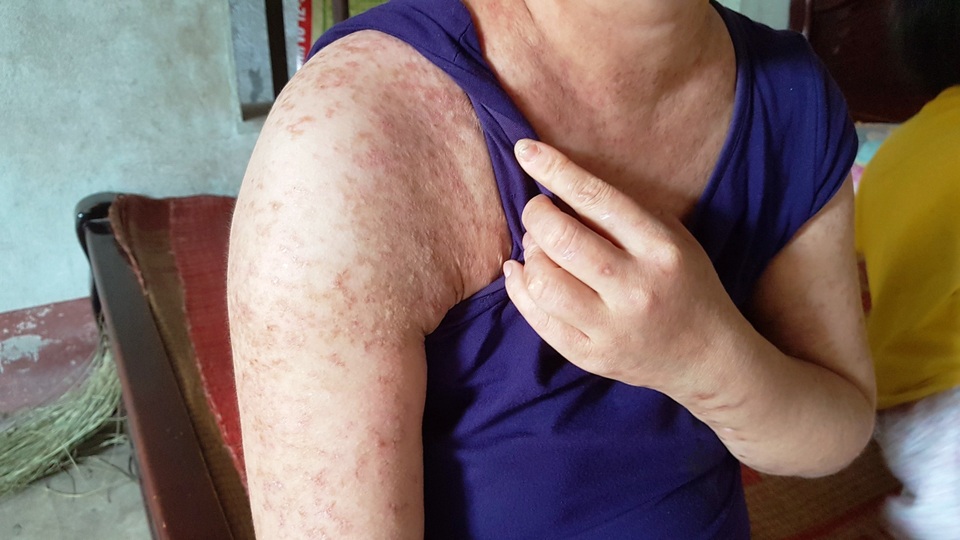 Người đàn bà khốn khổ ở viện nhiều hơn ở nhà vì mắc bệnh hiểm - 4 Người đàn bà khốn khổ ở viện nhiều hơn ở nhà vì mắc bệnh hiểm - 4