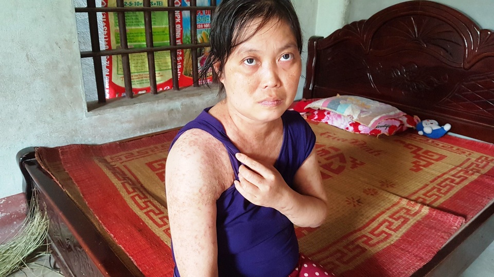 Mẹ con chị “Thơm Lupus ban đỏ” được bạn đọc giúp đỡ thêm 20 triệu đồng - 1 Mẹ con chị “Thơm Lupus ban đỏ” được bạn đọc giúp đỡ thêm 20 triệu đồng - 1