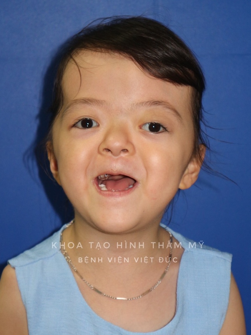 Cô bé mắc chứng hẹp hộp sọ được nới sọ thành công sau 6 lần phẫu thuật - 2 Cô bé mắc chứng hẹp hộp sọ được nới sọ thành công sau 6 lần phẫu thuật - 2