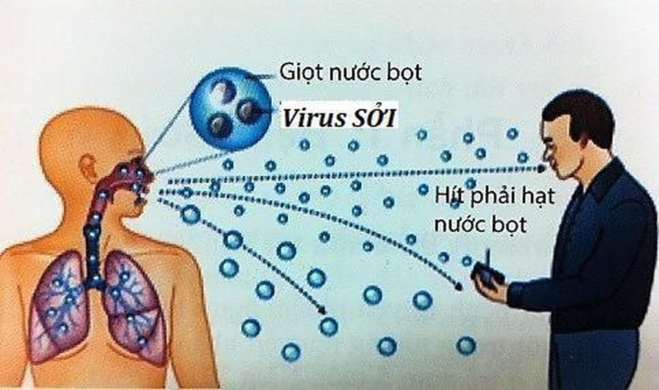 Cách nhận biết nhanh dấu hiệu của bệnh sởi - 1 Cách nhận biết nhanh dấu hiệu của bệnh sởi - 1