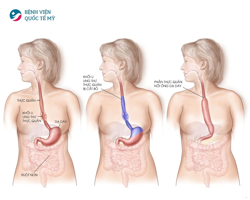 Điều trị ung thư thực quản tiêu chuẩn Mỹ ngay tại Việt Nam - 2 Điều trị ung thư thực quản tiêu chuẩn Mỹ ngay tại Việt Nam - 2