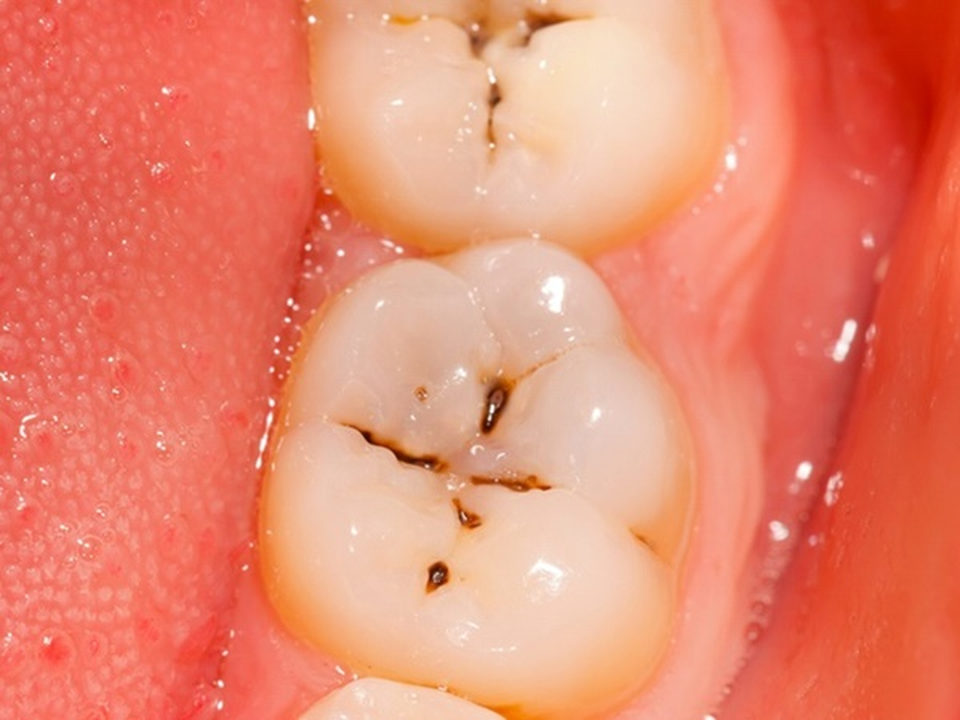 Hôi miệng có nguồn gốc từ đâu? - 1 Hôi miệng có nguồn gốc từ đâu? - 1
