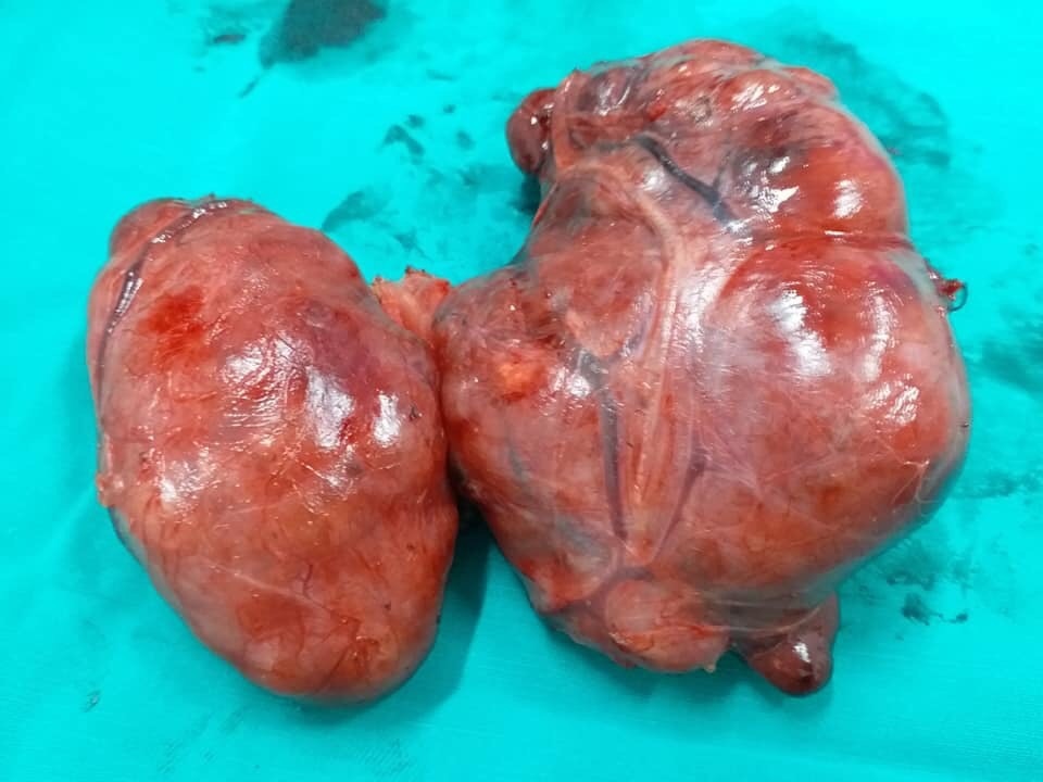 Phẫu thuật thành công u bướu “khổng lồ” ở bệnh nhân 76 tuổi - 4 Phẫu thuật thành công u bướu “khổng lồ” ở bệnh nhân 76 tuổi - 4