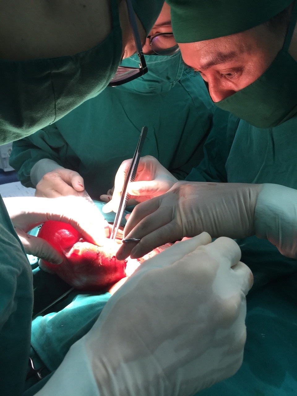 Phẫu thuật thành công u bướu “khổng lồ” ở bệnh nhân 76 tuổi - 2 Phẫu thuật thành công u bướu “khổng lồ” ở bệnh nhân 76 tuổi - 2