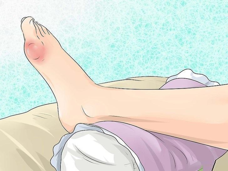 Cách giảm đau khớp do bệnh gút ngay tại nhà - 1 Cách giảm đau khớp do bệnh gút ngay tại nhà - 1