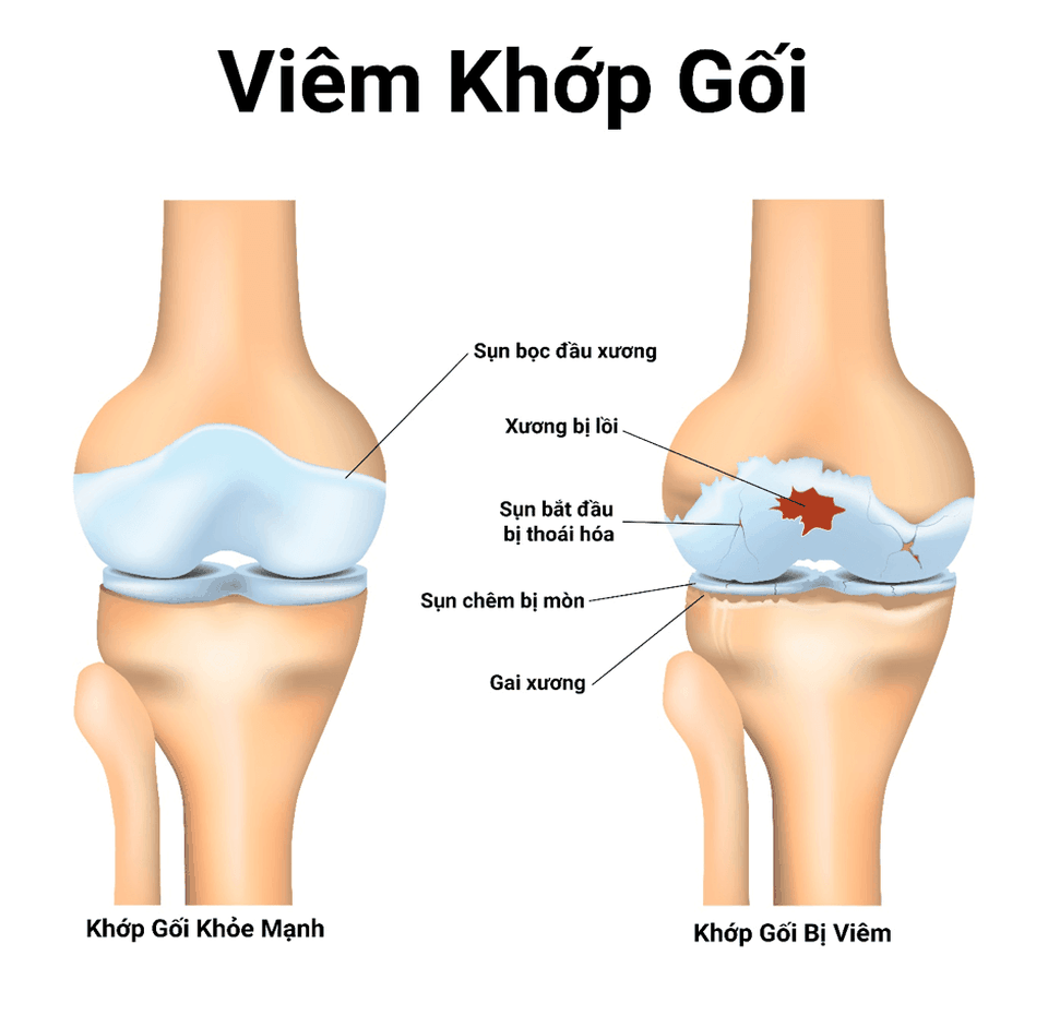Bệnh viêm khớp gối: Nguyên nhân và cách điều trị hiệu quả - 1 Bệnh viêm khớp gối: Nguyên nhân và cách điều trị hiệu quả - 1
