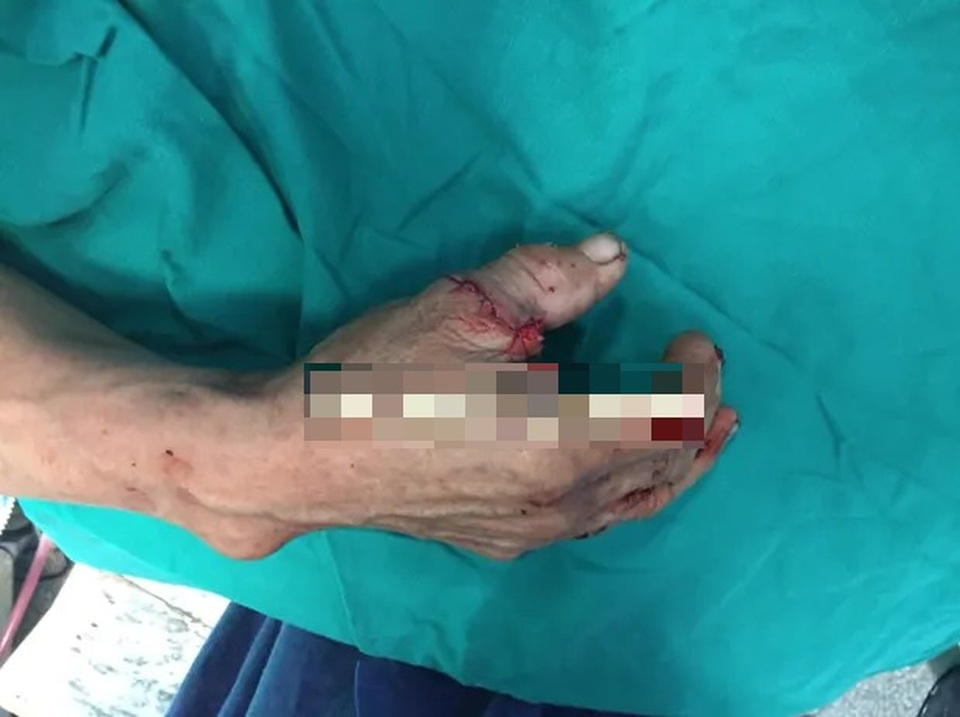 Nối lại thành công ngón tay cái đứt rời bằng kỹ thuật vi phẫu - 1 Nối lại thành công ngón tay cái đứt rời bằng kỹ thuật vi phẫu - 1