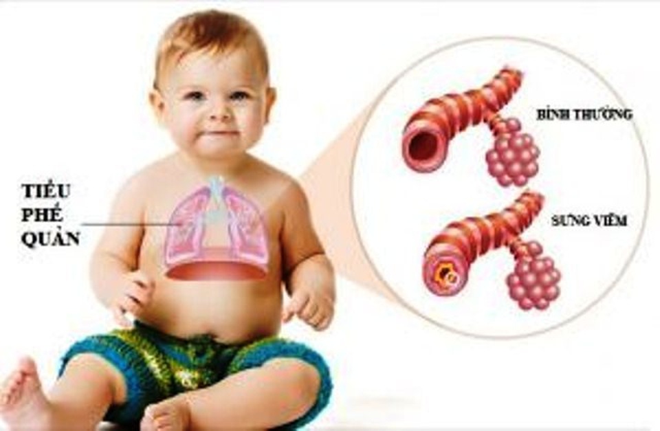 Viêm tiểu phế quản không chữa kịp thời dễ gây suy hô hấp, trẻ tử vong - 1
