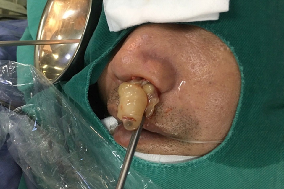 10 năm điếc ngửi, bác sĩ lôi ra thủ phạm chình ình trong mũi - 1