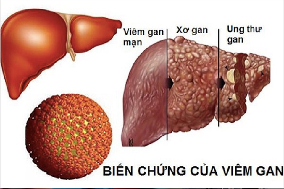 Viêm gan B lây lan nhanh hơn HIV gấp 100 lần, dùng chung bát đũa có lây? - 1 Viêm gan B lây lan nhanh hơn HIV gấp 100 lần, dùng chung bát đũa có lây? - 1