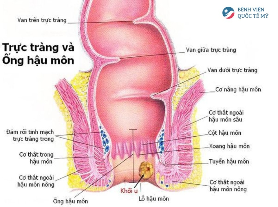 Thoát khỏi nỗi sợ ung thư hậu môn nhờ kết hợp các phương pháp điều trị chuẩn Mỹ - 1 Thoát khỏi nỗi sợ ung thư hậu môn nhờ kết hợp các phương pháp điều trị chuẩn Mỹ - 1