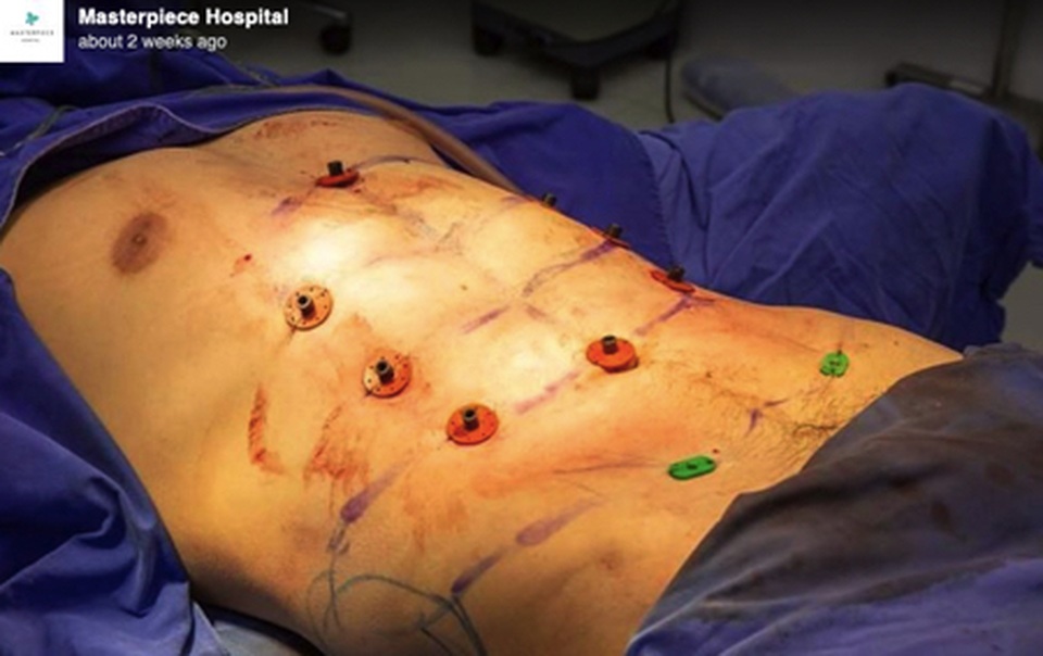 Dịch vụ phẫu thuật cơ bụng 6 múi lên ngôi - 2