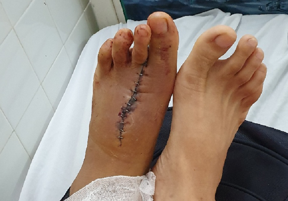 “Đào” ngón chân trái làm ngón cái của bàn tay phải - 3 “Đào” ngón chân trái làm ngón cái của bàn tay phải - 3