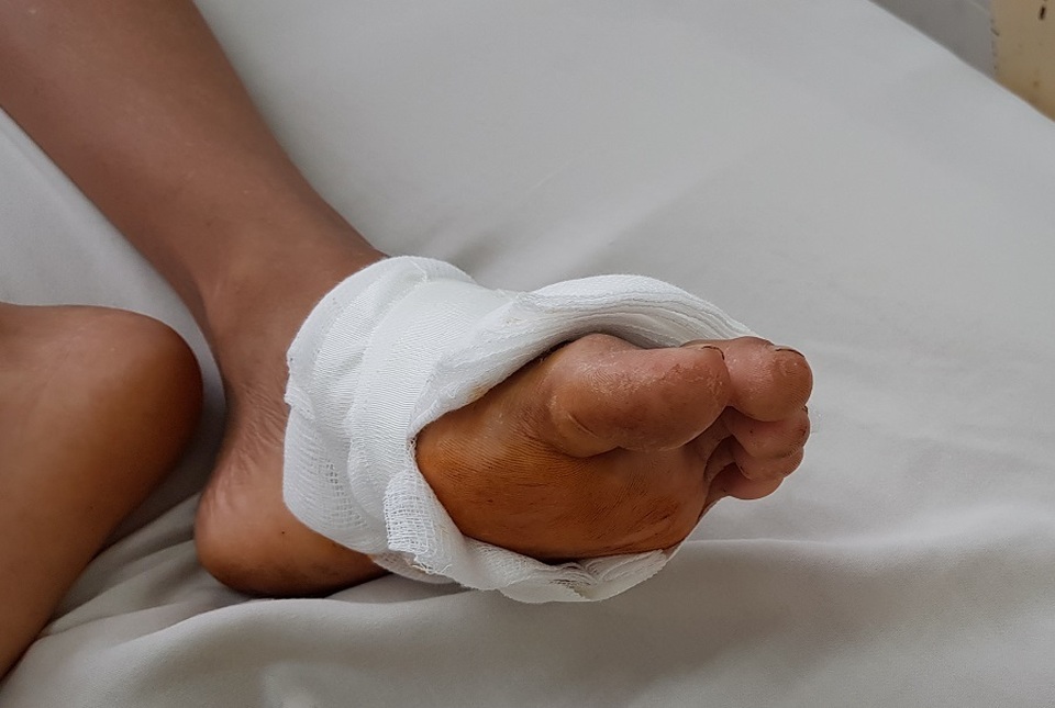 Bé 11 tuổi suýt chết vì vết thương nhỏ ở lòng bàn chân - 1 Bé 11 tuổi suýt chết vì vết thương nhỏ ở lòng bàn chân - 1