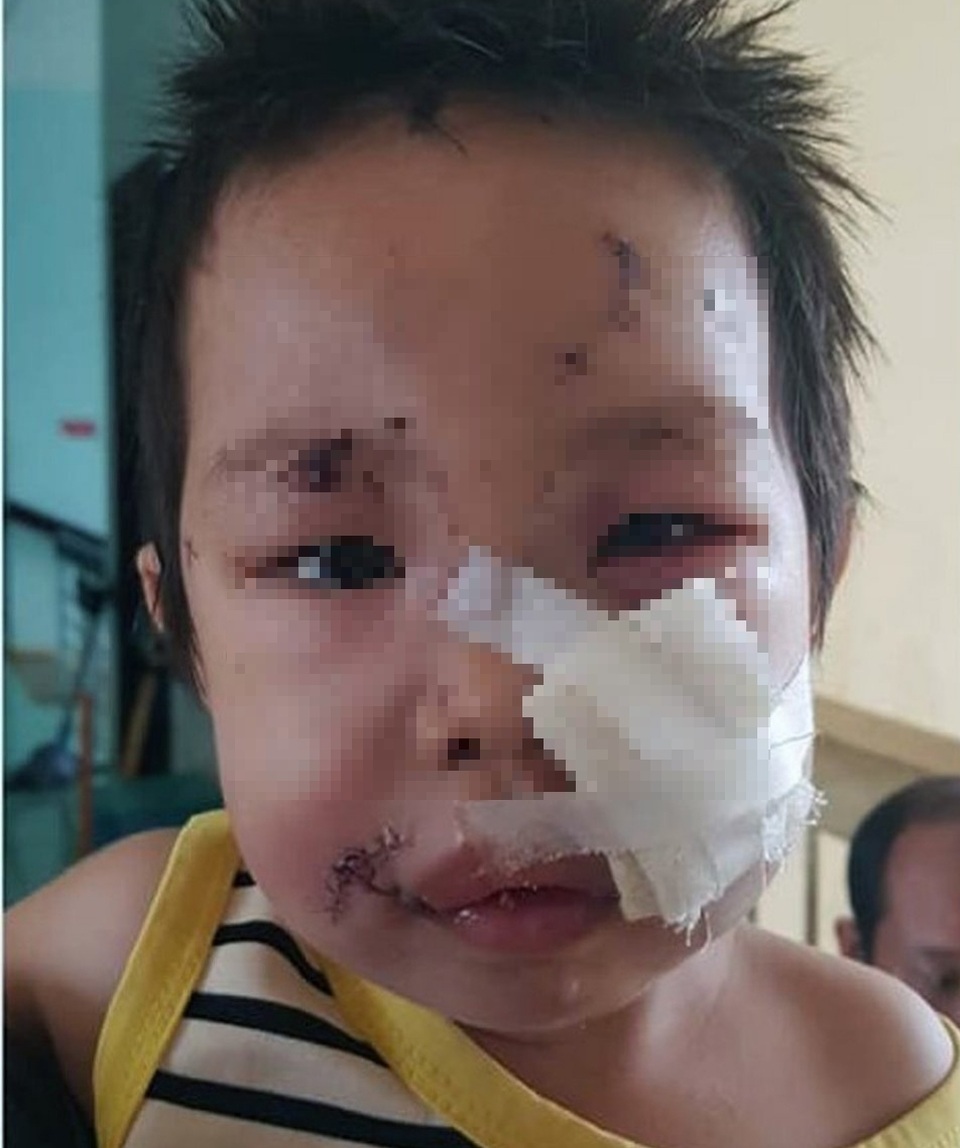 Hai chị em bị thương nặng do chó nhà hàng xóm tấn công - 1 Hai chị em bị thương nặng do chó nhà hàng xóm tấn công - 1