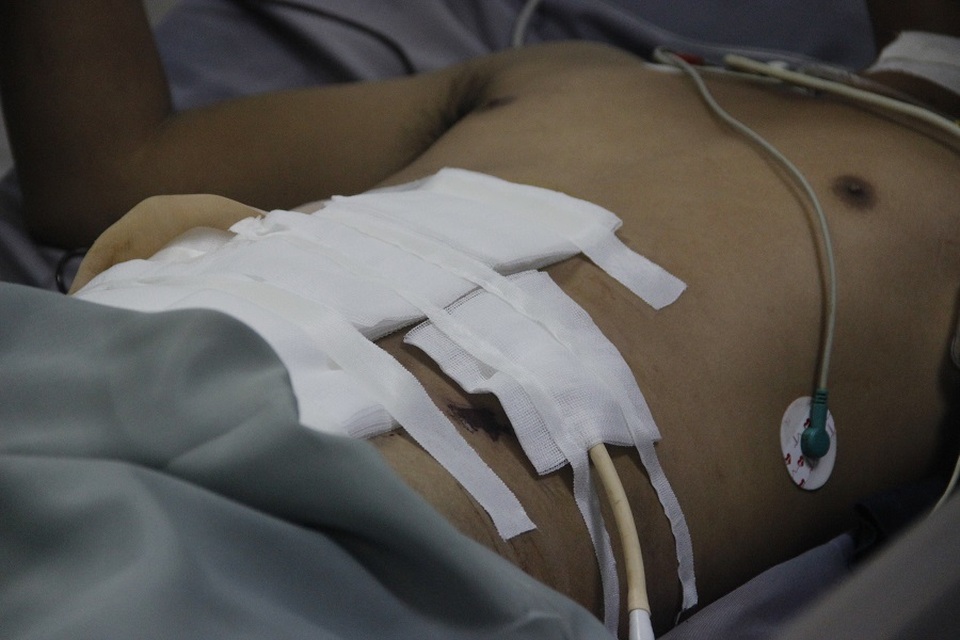 Ổ bụng ngập máu vì bị thanh sắt rơi trúng - 1 Ổ bụng ngập máu vì bị thanh sắt rơi trúng - 1