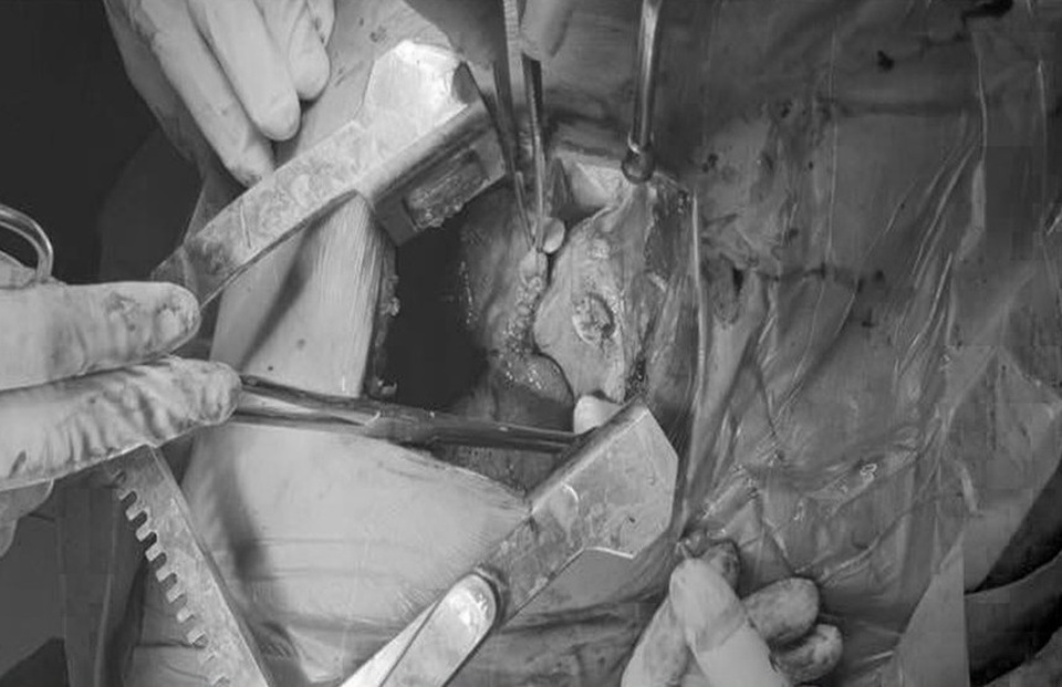 Nam thanh niên dùng dao tự đâm xuyên tim, thấu phổi - 1