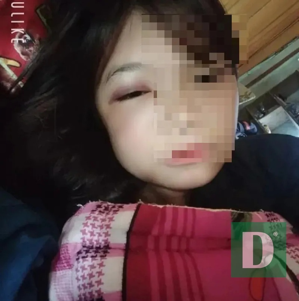 Nữ sinh lớp 10 bị 2 bạn nữ đánh tím mắt, sưng mặt - 1