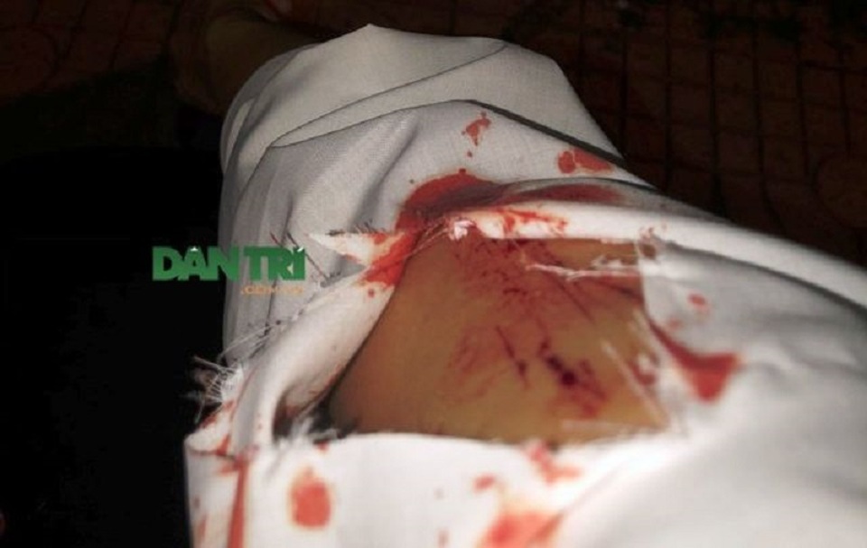 Cần làm gì khi bị kim dính máu nghi nhiễm HIV đâm? - 1