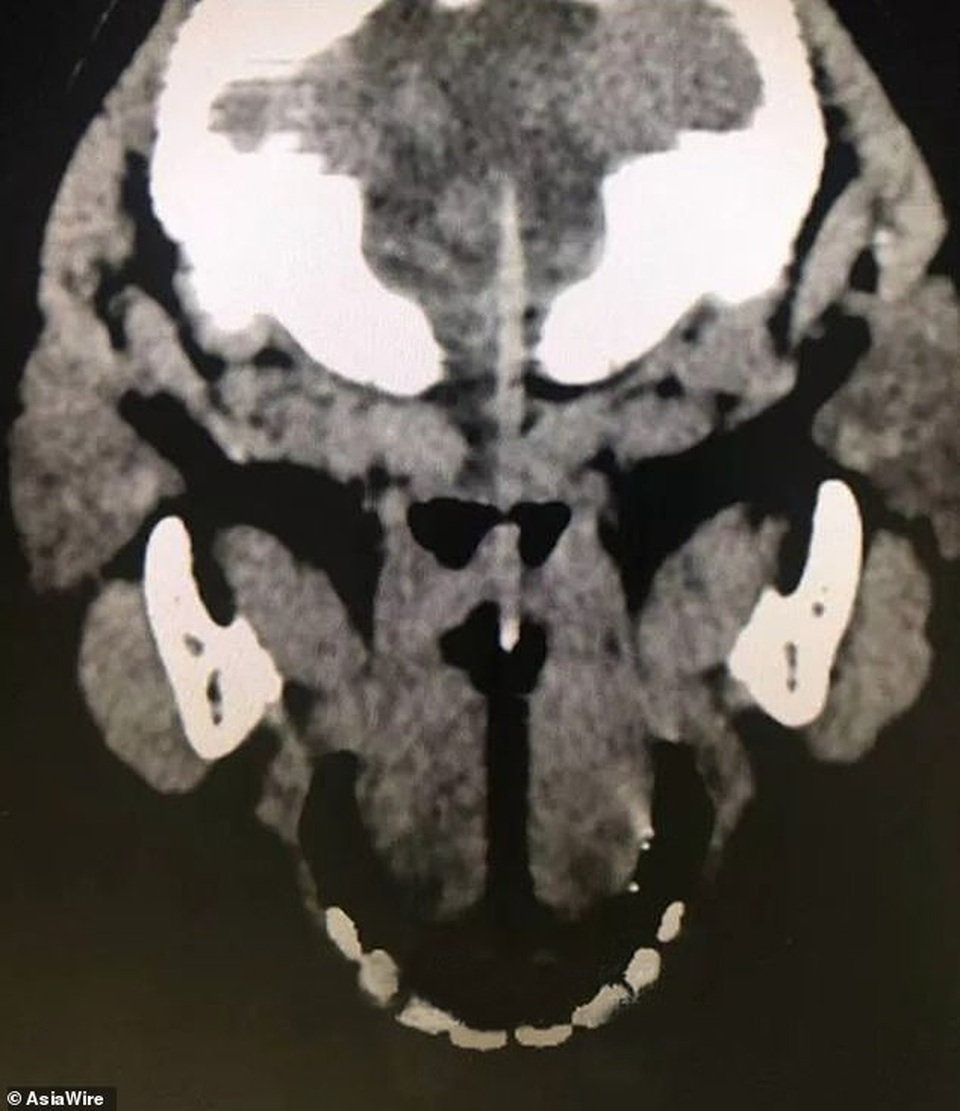 Bị que xiên xúc xích dài 10cm đâm vào não, bé trai 3 tuổi sống sót thần kỳ - 2 Bị que xiên xúc xích dài 10cm đâm vào não, bé trai 3 tuổi sống sót thần kỳ - 2