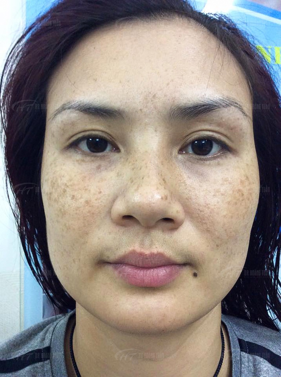 Bí quyết trị nám – tàn nhang 5 năm không tái phát của Hoa khôi “dầm mưa dãi nắng” - 1 Bí quyết trị nám – tàn nhang 5 năm không tái phát của Hoa khôi “dầm mưa dãi nắng” - 1