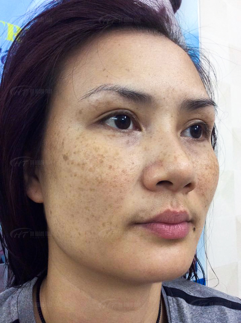 Bí quyết trị nám – tàn nhang 5 năm không tái phát của Hoa khôi “dầm mưa dãi nắng” - 2 Bí quyết trị nám – tàn nhang 5 năm không tái phát của Hoa khôi “dầm mưa dãi nắng” - 2