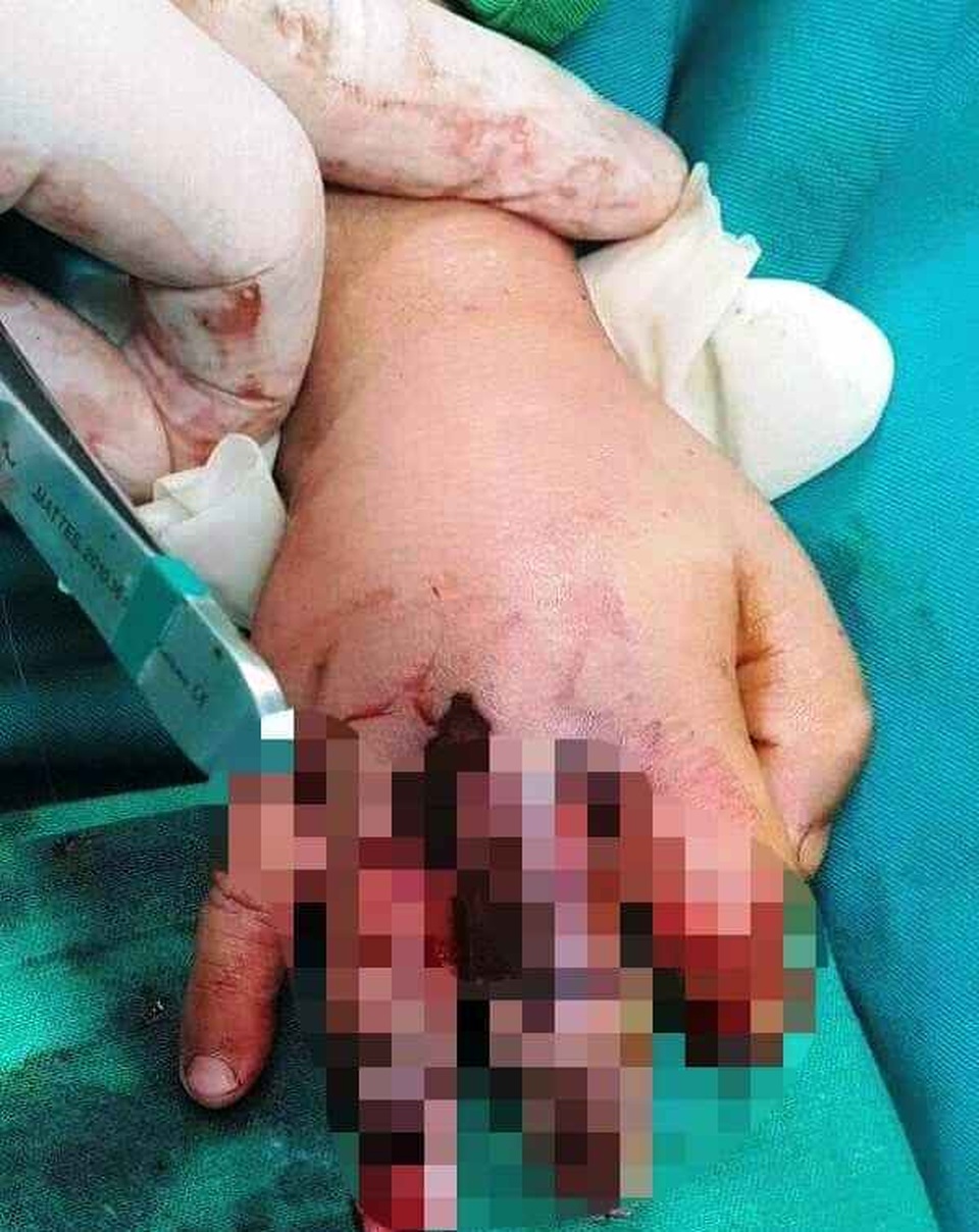 Bé trai 4 tuổi bị dập nát đốt tay vì kẹt tay vào máy ép mía - 1 Bé trai 4 tuổi bị dập nát đốt tay vì kẹt tay vào máy ép mía - 1
