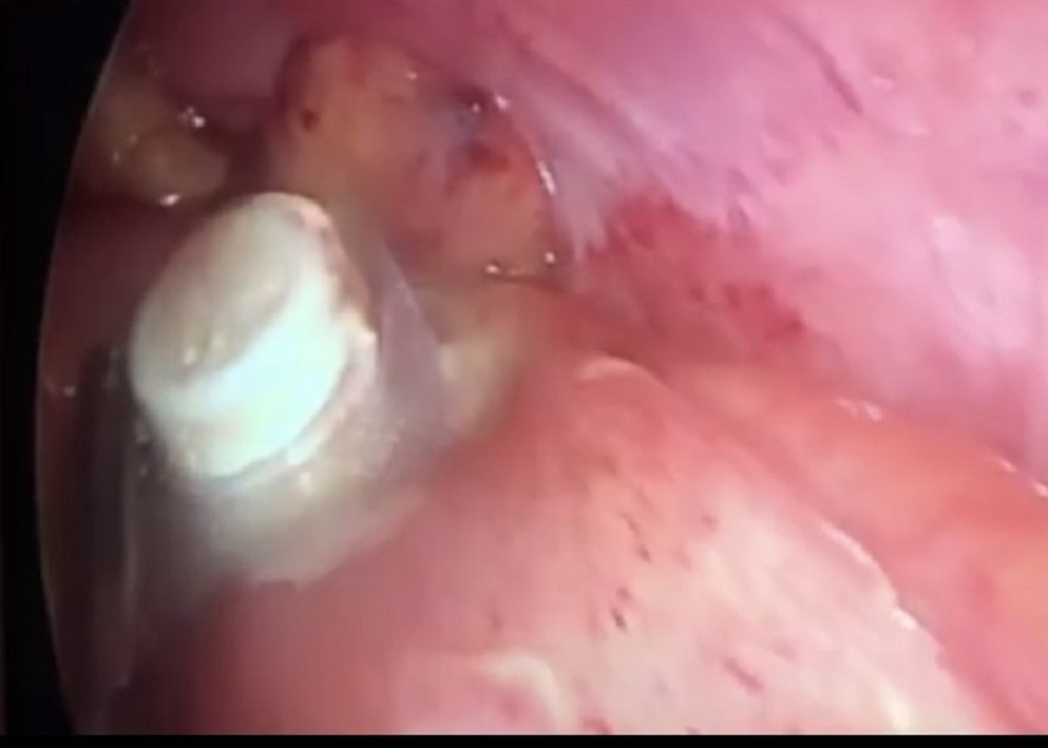 Nam bệnh nhân thủng ruột vì uống thuốc còn nguyên vỉ - 1 Nam bệnh nhân thủng ruột vì uống thuốc còn nguyên vỉ - 1
